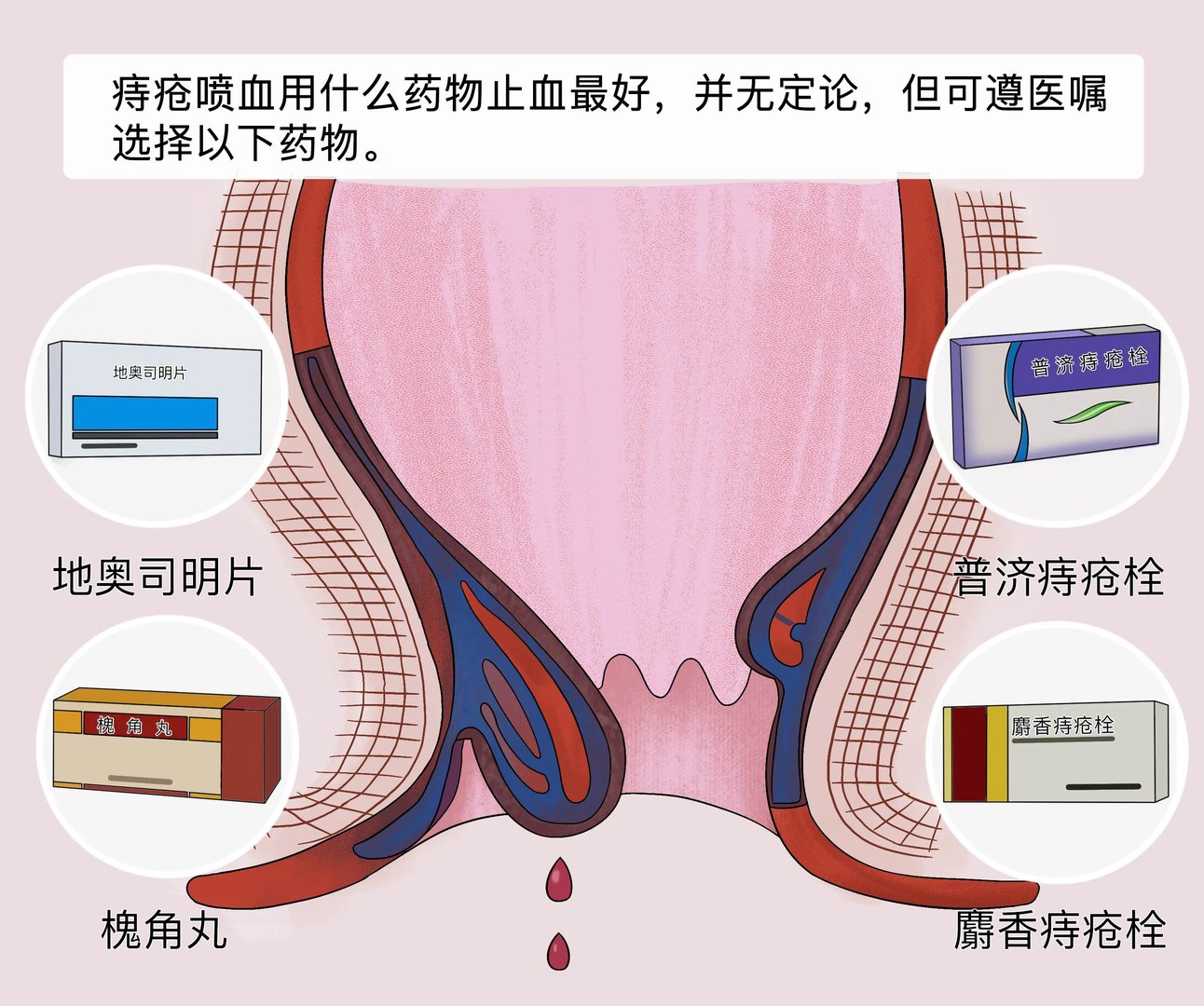 痔疮喷血用什么药止血最好