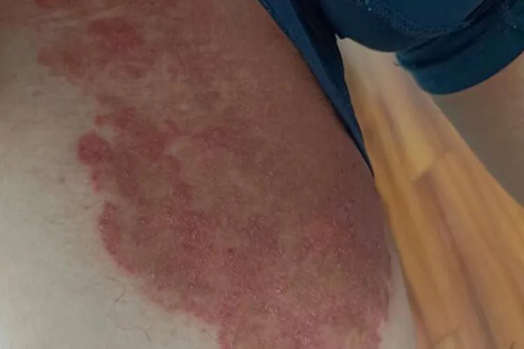 男性烧裆图片和症状