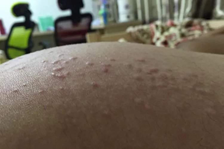 身上起了小米粒很痒图