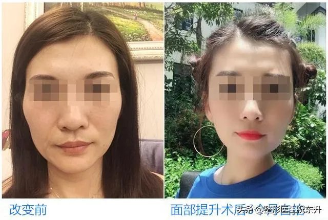 脸上皮肤松弛怎么办?