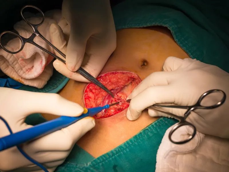 急性阑尾炎术后护理细节