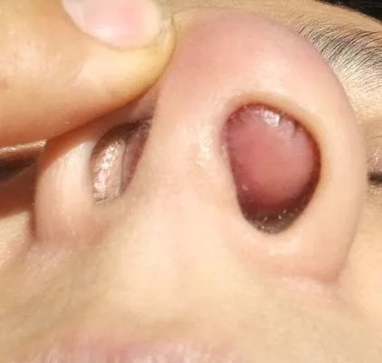 鼻前庭囊肿的症状