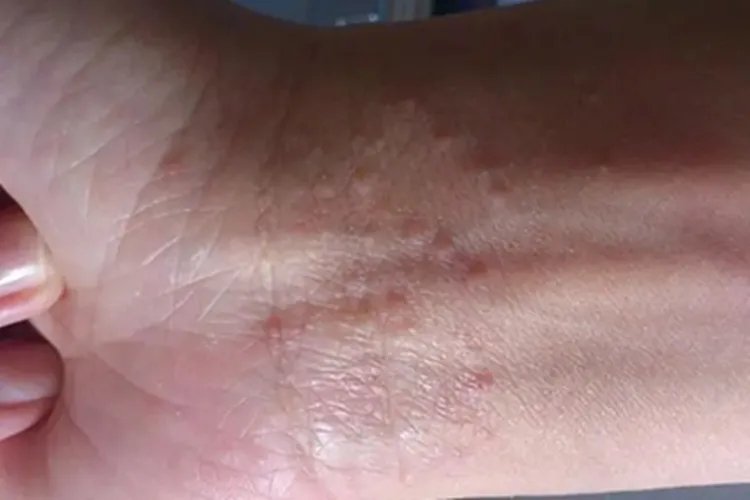 身上起了小米粒很痒图