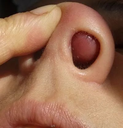 鼻前庭囊肿的症状