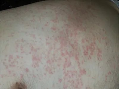 慢性湿疹小红疙瘩图片
