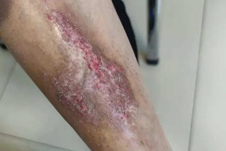 皮肤湿毒症状图片
