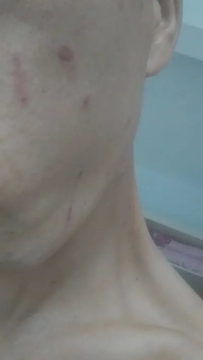 牙膏能祛痘吗？