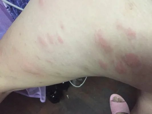 药疹的症状