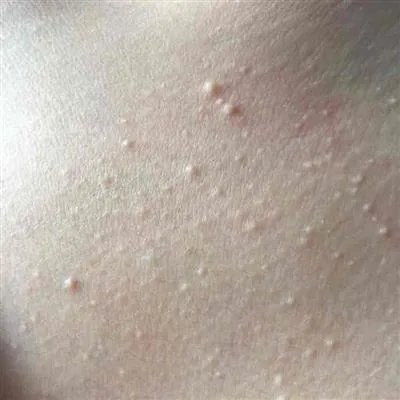 扁平疣怎么治好的