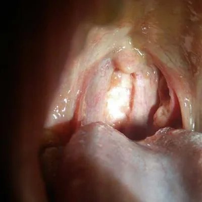舌下腺囊肿症状?
