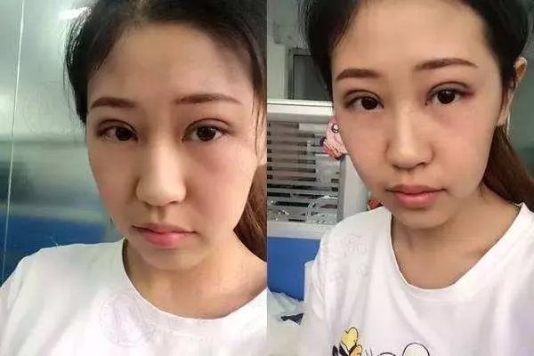 5s重睑术有失败的吗 5s重睑术的优点有哪些