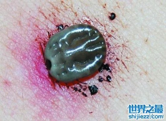 可怕！蜱虫叮咬后伤口图片竟是这样，咬伤后必须恰当处理！ ... 