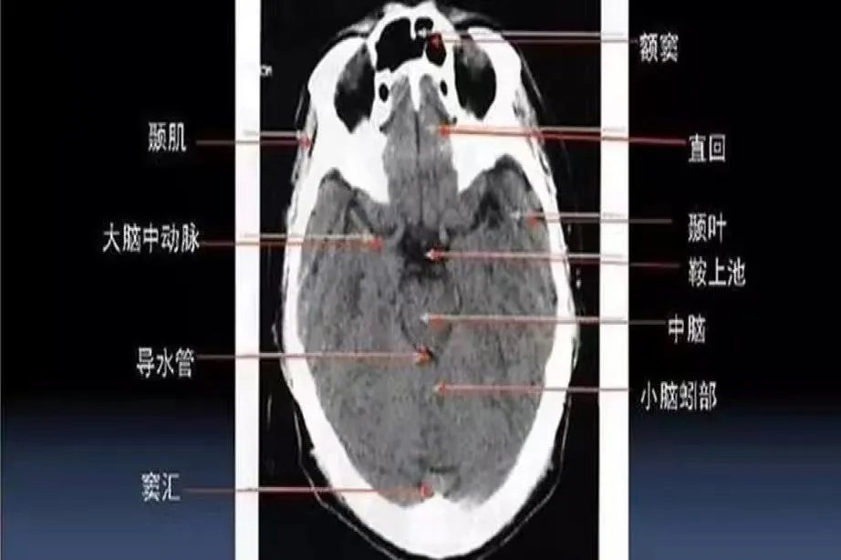头颅ct断层解剖图
