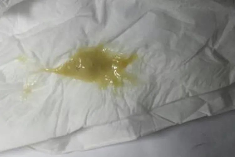 痰的颜色与对应图片
