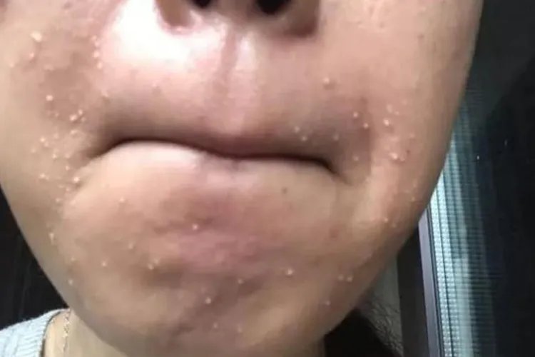 皮肤痤疮图片大全