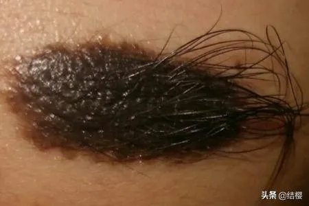 黑痣是怎么形成的？如何去除黑痣？