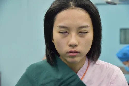女子割双眼皮失败老公闹离婚,双眼皮手术哪种情况下算是很成功?