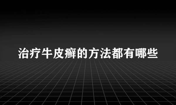 治疗牛皮癣的方法都有哪些