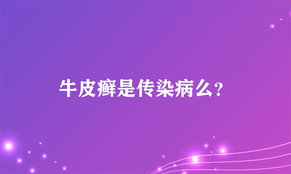 牛皮癣是传染病么?