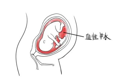 血性羊水图片
