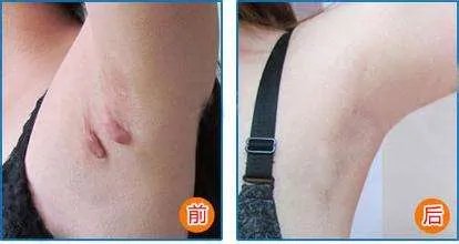 做手术疤痕修复费用大概需要多少