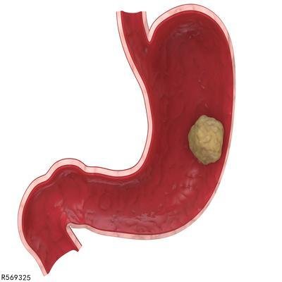 胃癌转移途径有哪些  胃癌3个常见转移途径详述