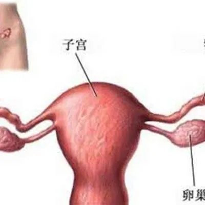 子宫腺癌是怎么回事