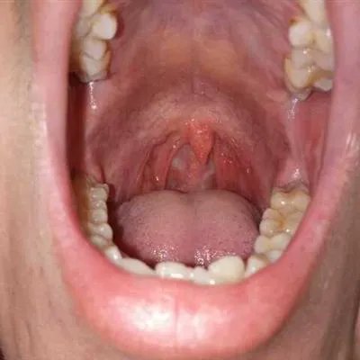舌下腺囊肿症状?