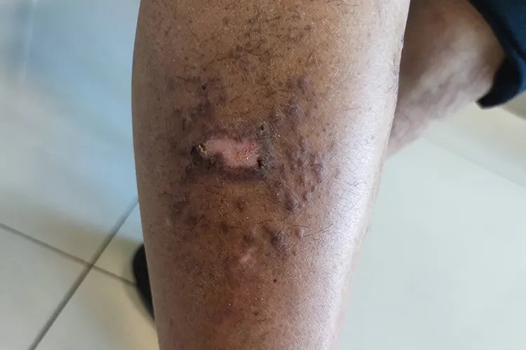 皮肤湿毒症状图片