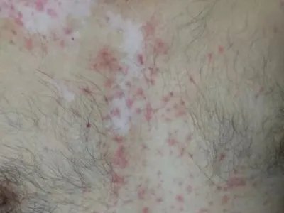 慢性湿疹小红疙瘩图片