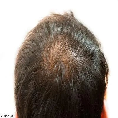 头发稀和斑秃有什么区别