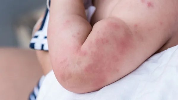 过敏性紫癜能治好吗