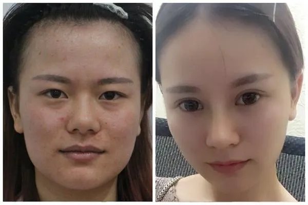 5s重睑术有失败的吗 5s重睑术的优点有哪些
