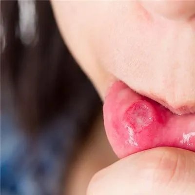 上火嘴唇起泡怎么办