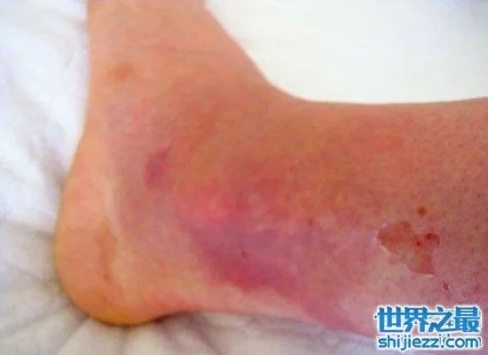 可怕!蜱虫叮咬后伤口图片竟是这样,咬伤后必须恰当处理! ...