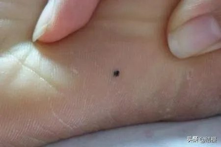 黑痣是怎么形成的？如何去除黑痣？