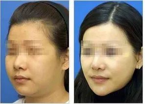 双下巴怎么减？减双下巴方法