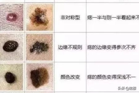 黑痣是怎么形成的？如何去除黑痣？