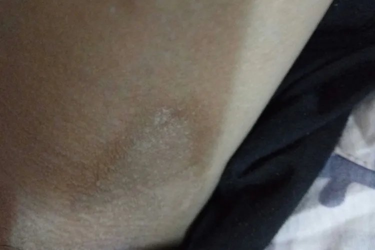 男性烧裆图片和症状