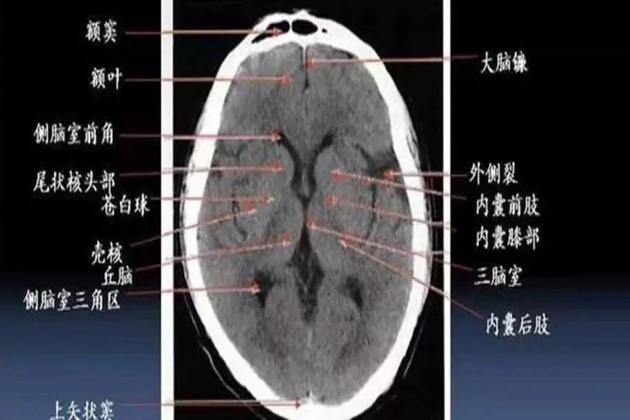 头颅ct断层解剖图