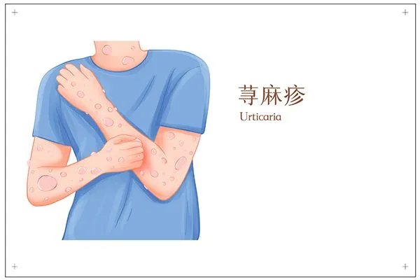 荨麻疹怎么治疗