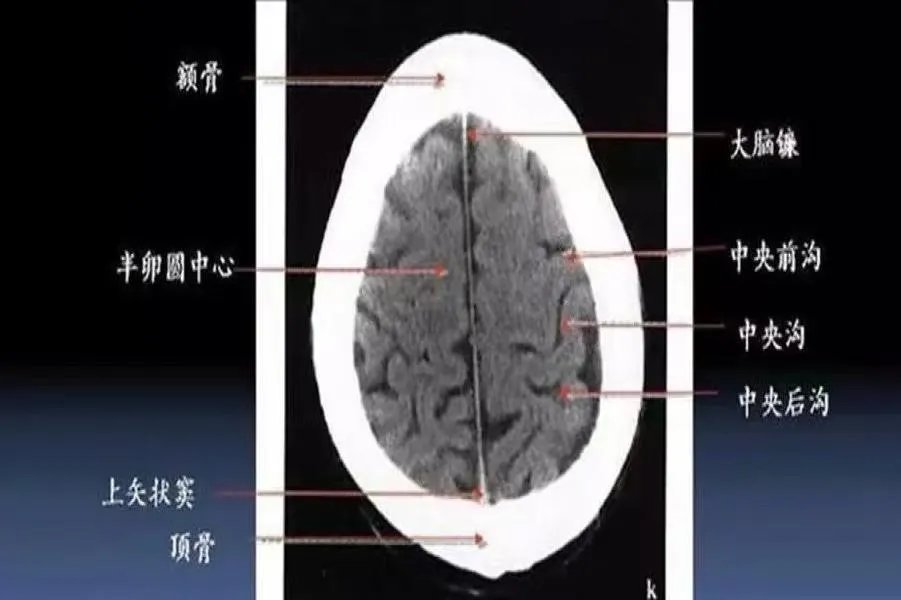 头颅ct断层解剖图