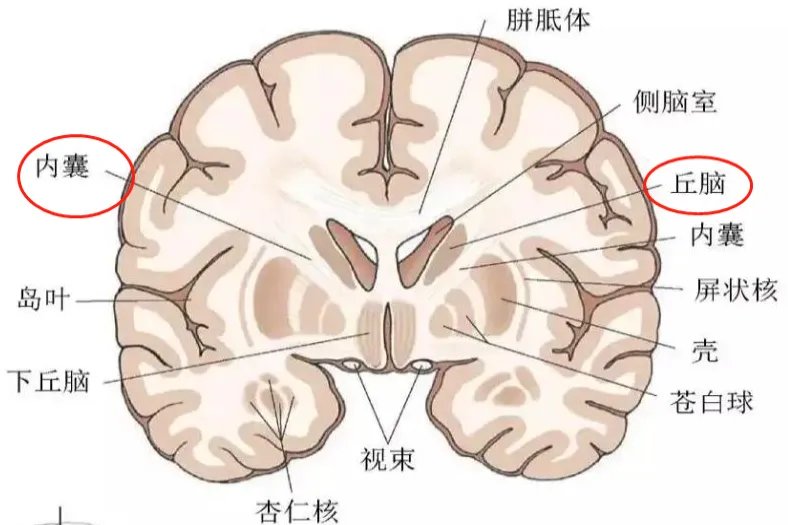 丘脑和内囊位置示意图