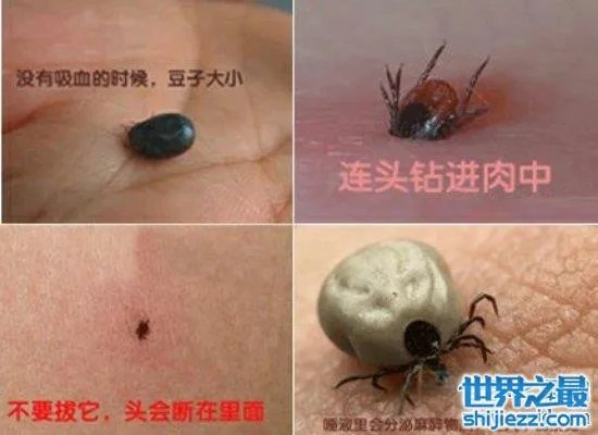可怕!蜱虫叮咬后伤口图片竟是这样,咬伤后必须恰当处理! ...
