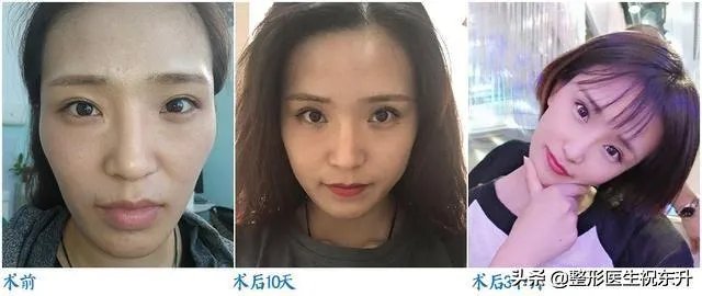 脸上皮肤松弛怎么办?