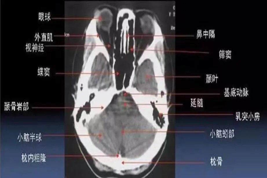 头颅ct断层解剖图