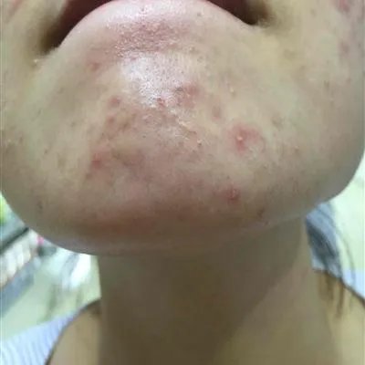 长痤疮的原因是什么