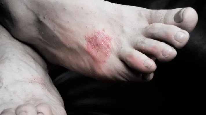 少年脓疱型银屑病费用高吗