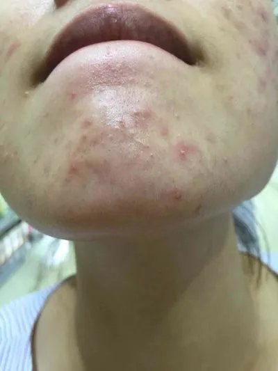 牙膏能祛痘吗？
