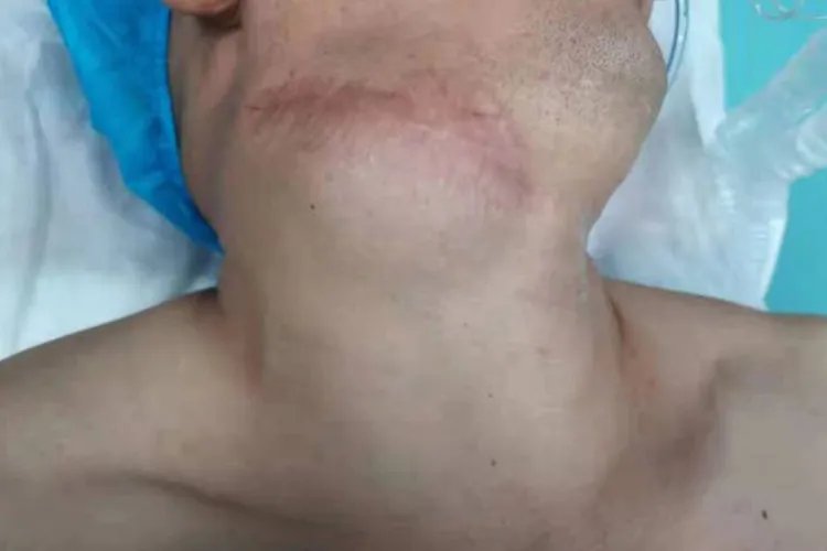 甲状腺未分化癌图片